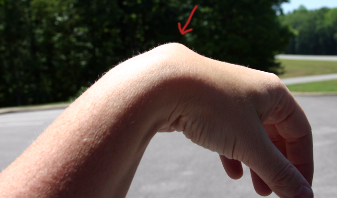 ganglion